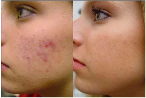 acne treatment hampton quispamsis sussex